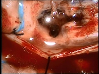 Omurilik Tümörü Ameliyatı