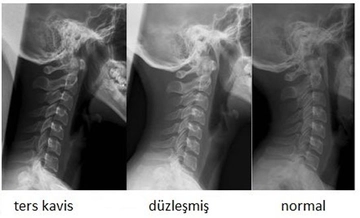 Omurilik Düzleşmesi Belirtileri ve Tedavisi